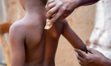 UN official says Burundi can end mpox outbreak soon